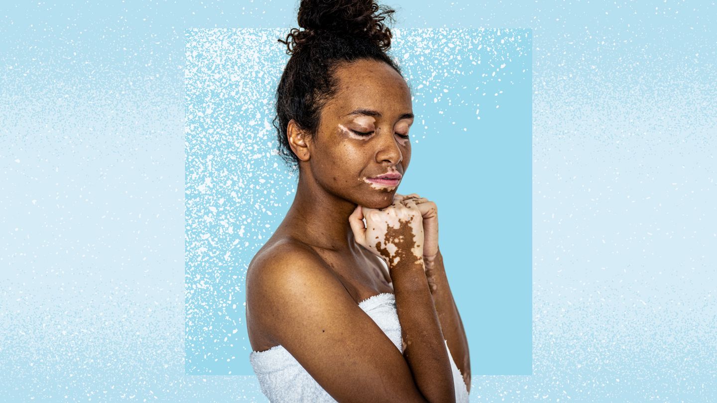 Dermatologist Dr. Elizabeth Yun Treats Vitiligo, Psoriasis