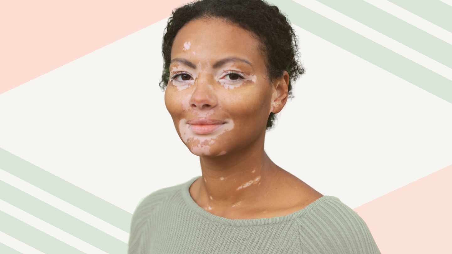 Buy Ruxolitinib Vitiligo Cream Online - Treatment Options, Prescriptions, Insurance