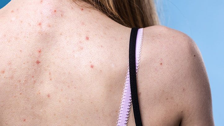 Back Acne Treatment: Before & After Results