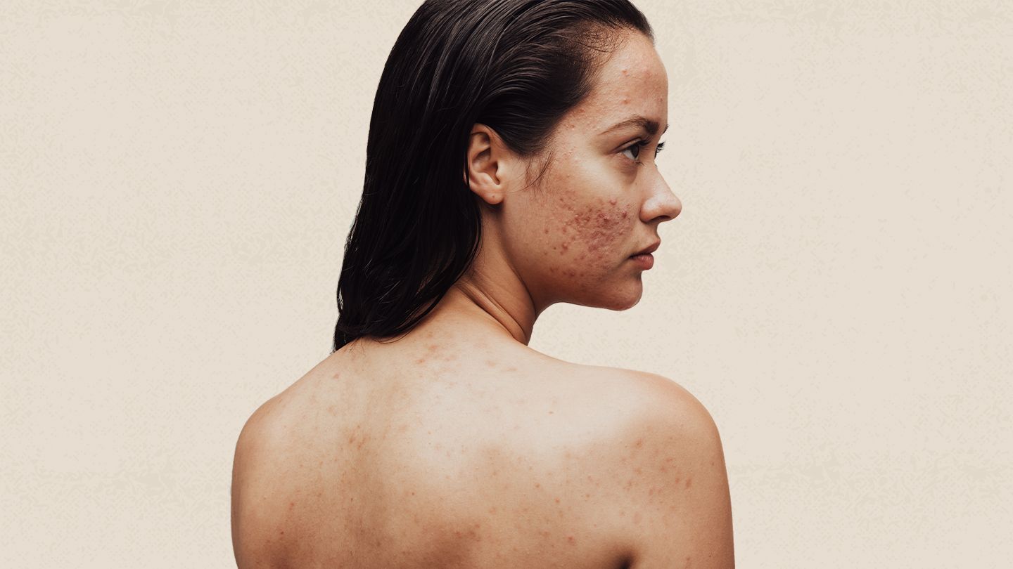 Making Peace with Acne: Coping with the Physical and Emotional Scars