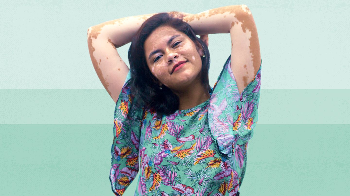 How to Pronounce Tinea Versicolor | Breaking Down the Name
