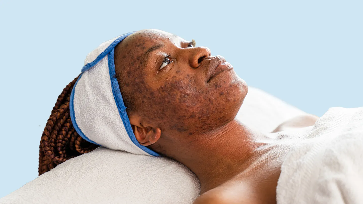 Best Body Washes for Clearing Up Body Acne Breakouts