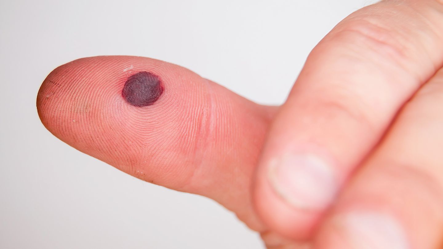 Black Spot Inside Cheek or Mouth: Cancer Sign or Harmless?