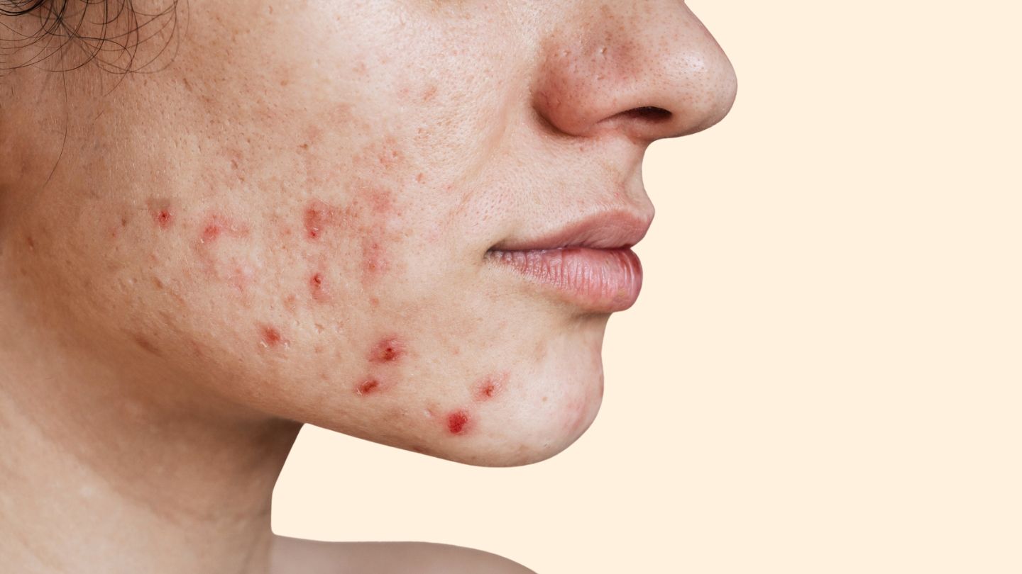 Does Ashwagandha Use Aggravate or Clear Up Acne Breakouts?