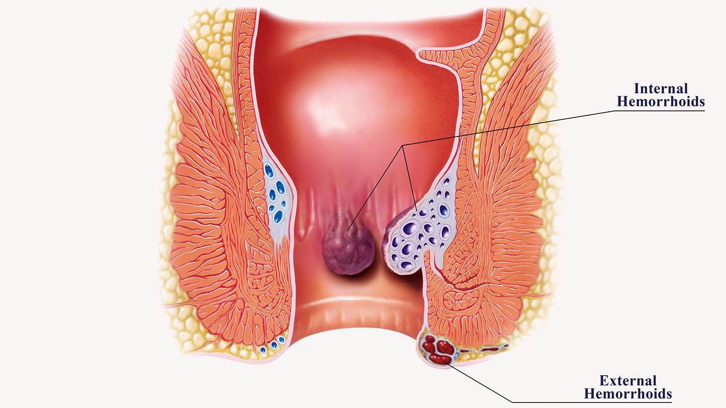 Can Stress Cause Hemorrhoids? The Possible Connection
