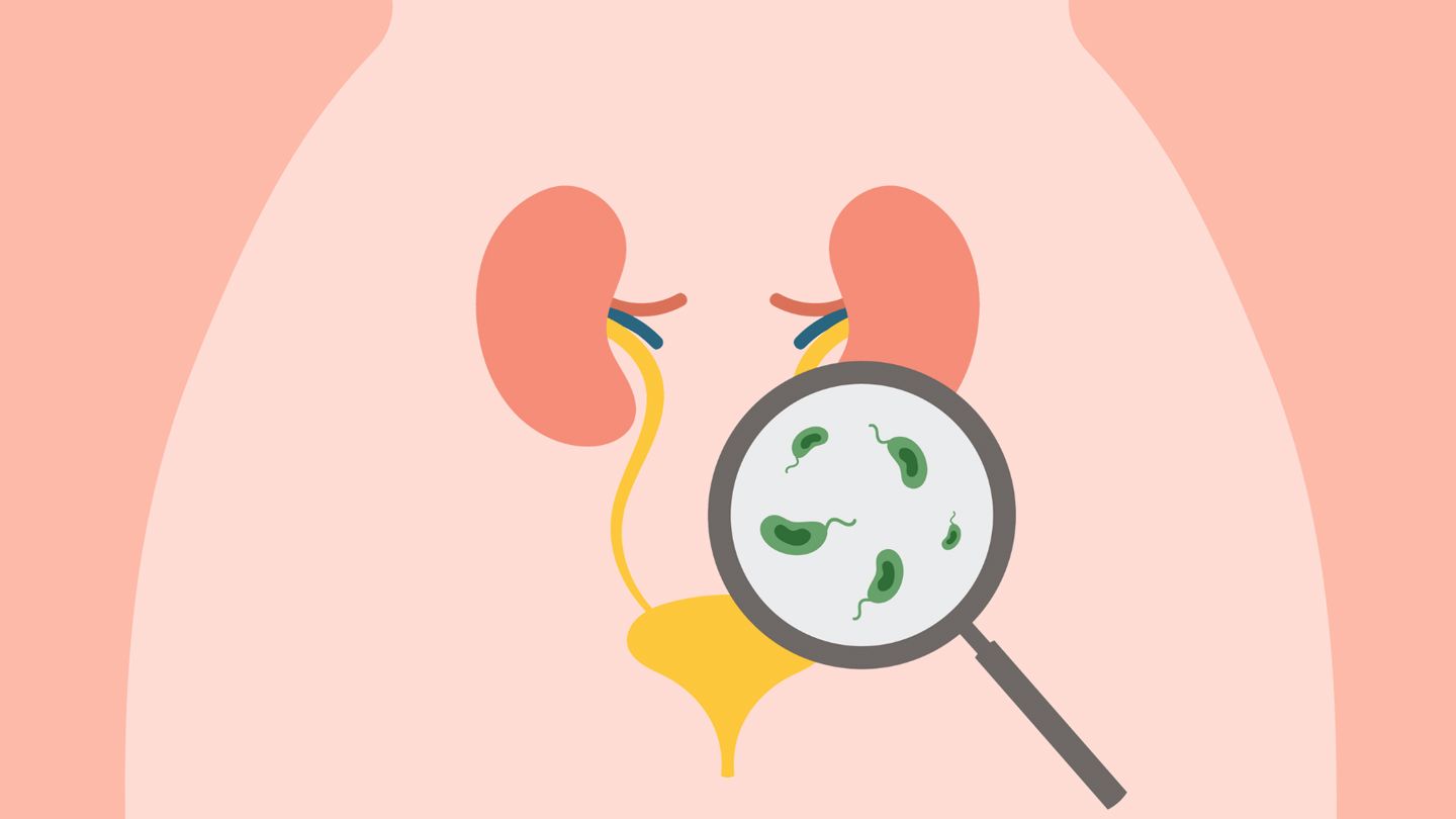 Treating Urinary Tract Infections (UTIs) With Antibiotics