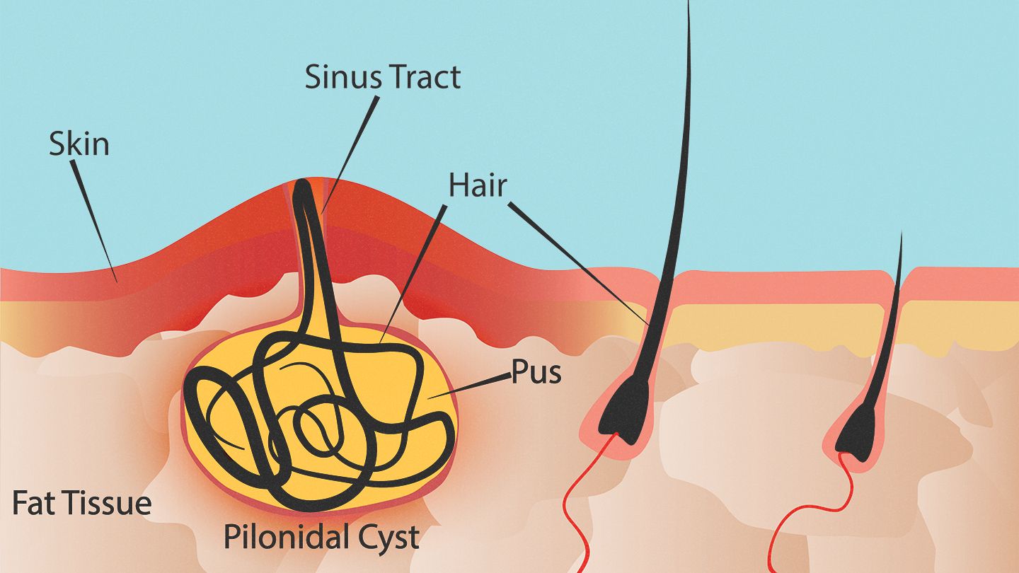 Proper Pronunciation of Mucus: Causes, Symptoms and Treatments
