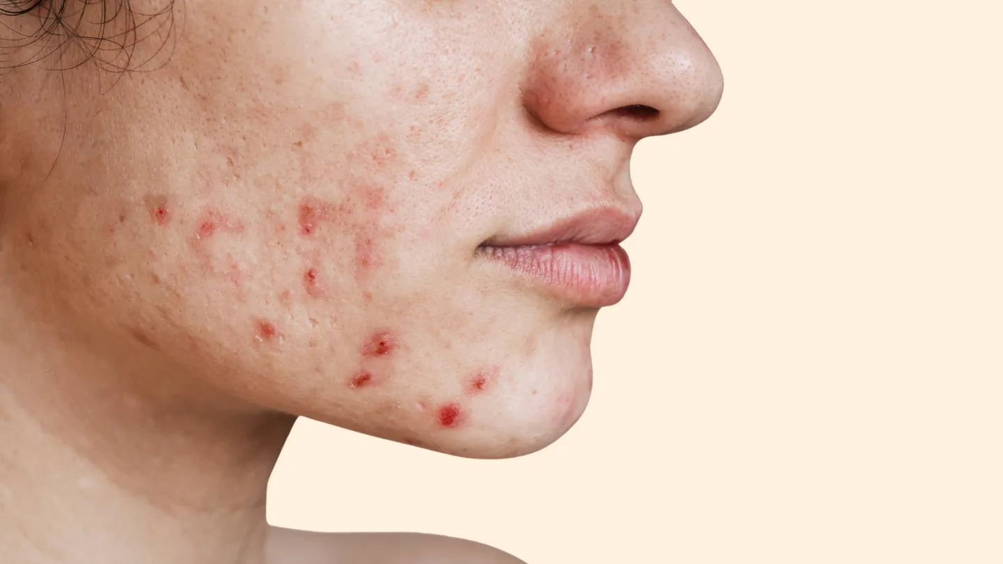 Understanding the Top Prescription Medications for Clearing Acne