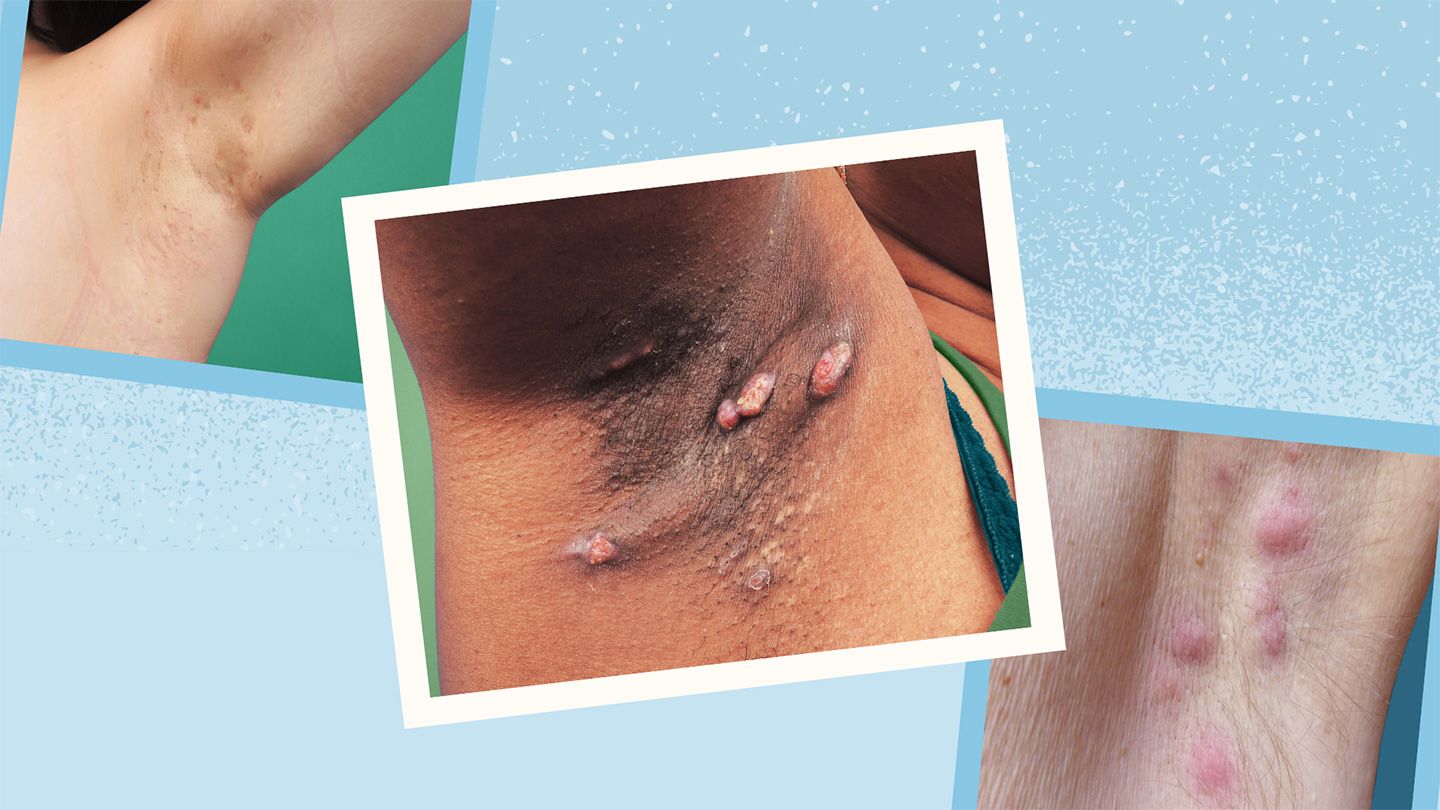Hidradenitis Suppurativa: Symptoms, Causes, Stages, Diagnosis, and Treatment