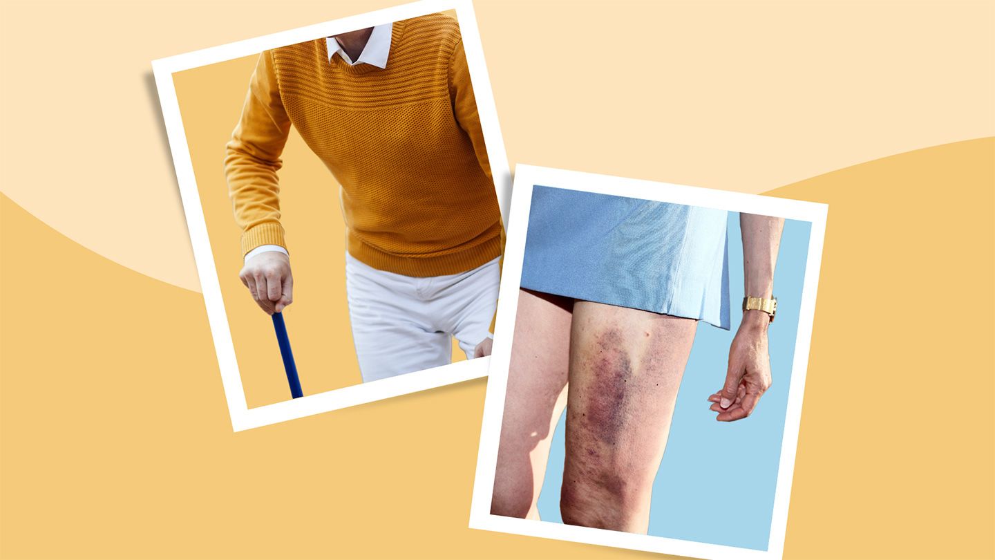 Understanding Pinched Hip Flexor Pain: Causes, Symptoms and Treatment
