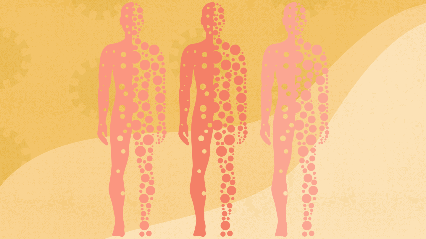 Sjögren's Syndrome Increases Kidney Stone Risk: Causes and Prevention