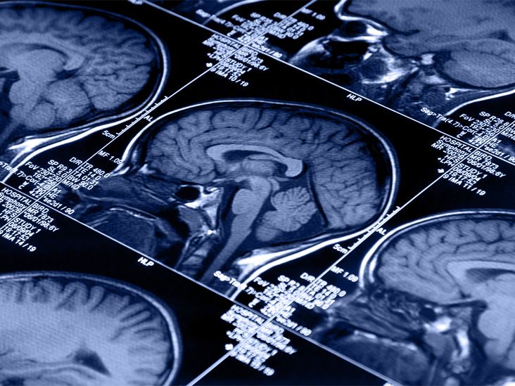 Temporal Lobe ADD: Myths, Facts, and What You Really Need to Know
