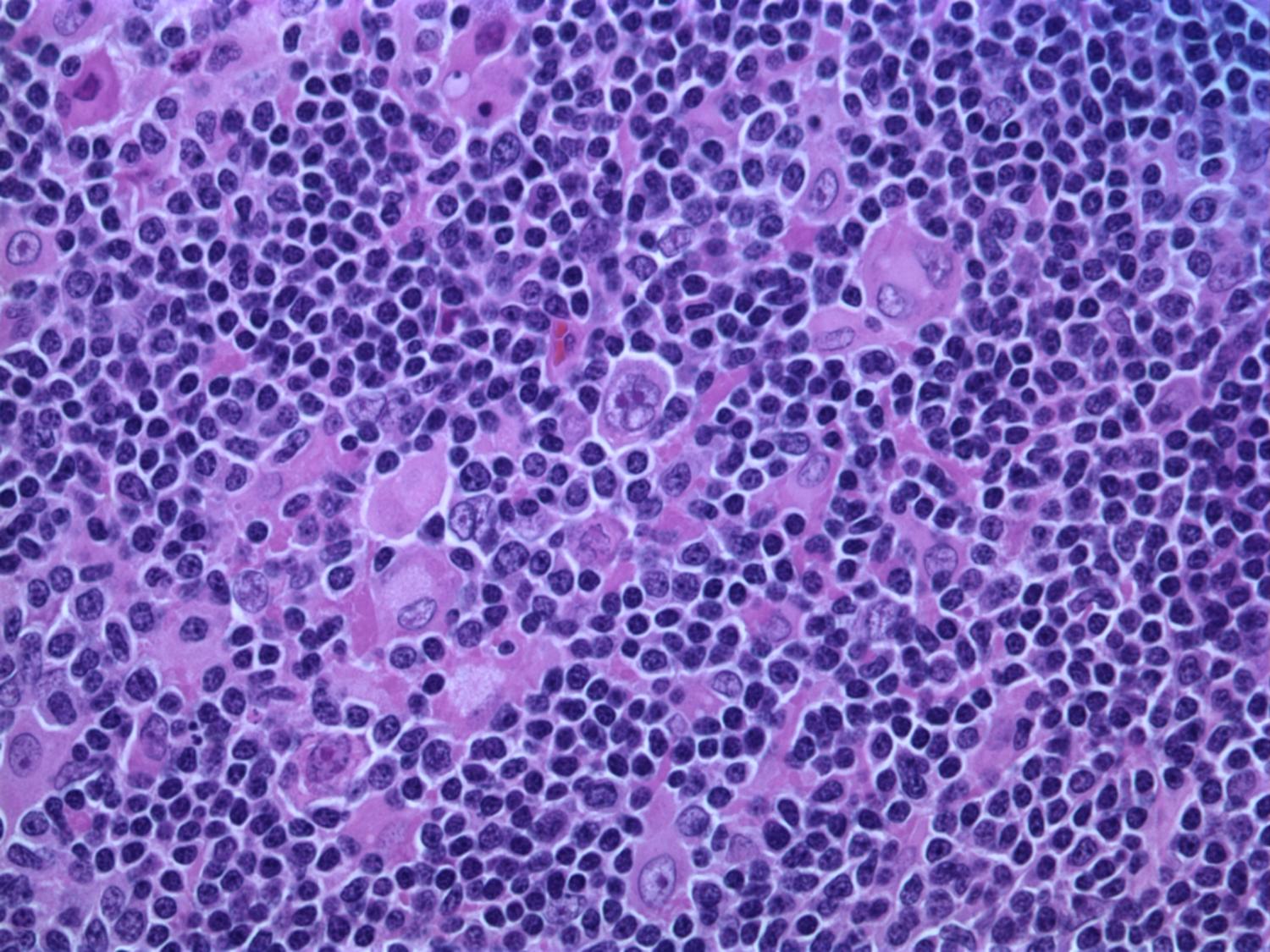 Diffuse Large B‑Cell Lymphoma: What You Must Know