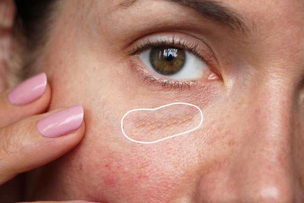 Do You Have Milia? 3 Must-Try Gentle Retinol Eye Creams